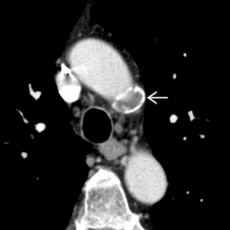 Axial CTA in the same patient 5 years following trauma shows calcification and thrombus  within a chronic posttraumatic aortic pseudoaneurysm.