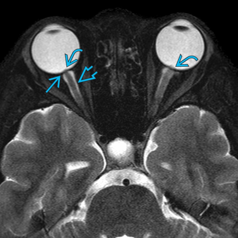 Axial T2 FS MR in a young obese female with headaches and visual symptoms shows flattening of the posterior sclera  and minimal protrusion of the optic nerve papilla  into the posterior globe. Note mild prominence of the CSF    along the optic nerve sheaths.