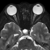 Axial T2 FS MR in a young obese female with headaches and visual symptoms shows flattening of the posterior sclera  and minimal protrusion of the optic nerve papilla  into the posterior globe. Note mild prominence of the CSF    along the optic nerve sheaths.