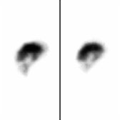 24-hour sagittal SPECT in the same patient demonstrates marked ventricle activity , confirming the presence of NPH.