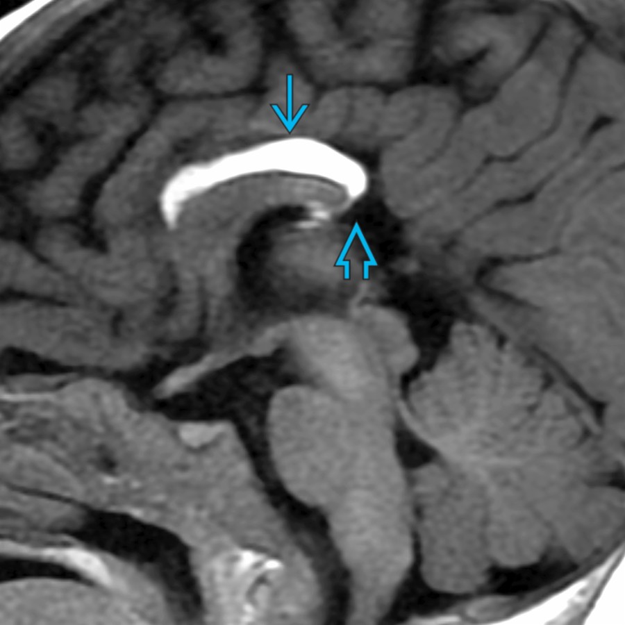 Midline sagittal T1 MR in a 4 month old shows a T1-hyperintense lipoma  along the dorsal CC with associated absence of the splenium .