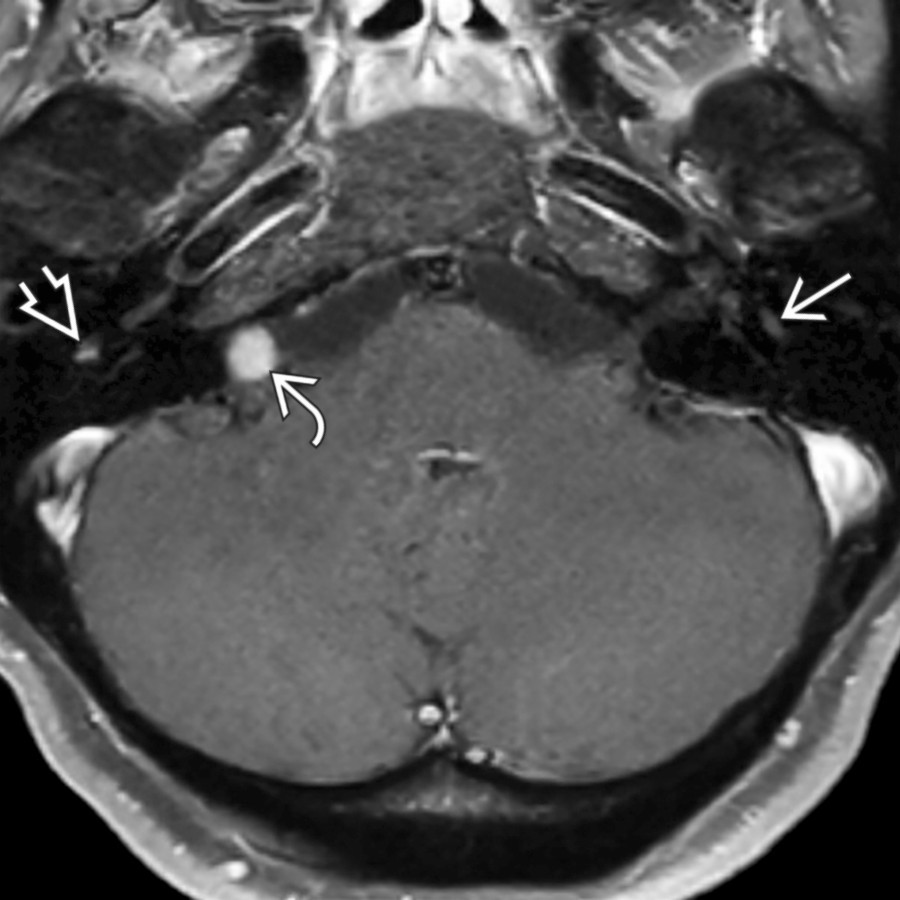 Axial (slightly oblique) MR in the same patient demonstrates little or no enhancement of the posterior genu  of the left facial nerve and subtle normal enhancement of the proximal mastoid segment  of the right facial nerve. The lower vestibular schwannoma    is noted.