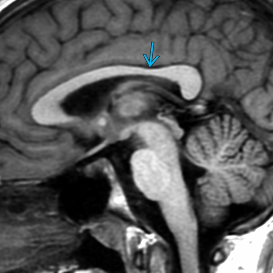Midline sagittal T1 MR in a 13 year old with headaches shows a normal variant morphology of the CC with relative thinning of the posterior body . This should not be mistaken for a sign of white matter (WM) volume loss.