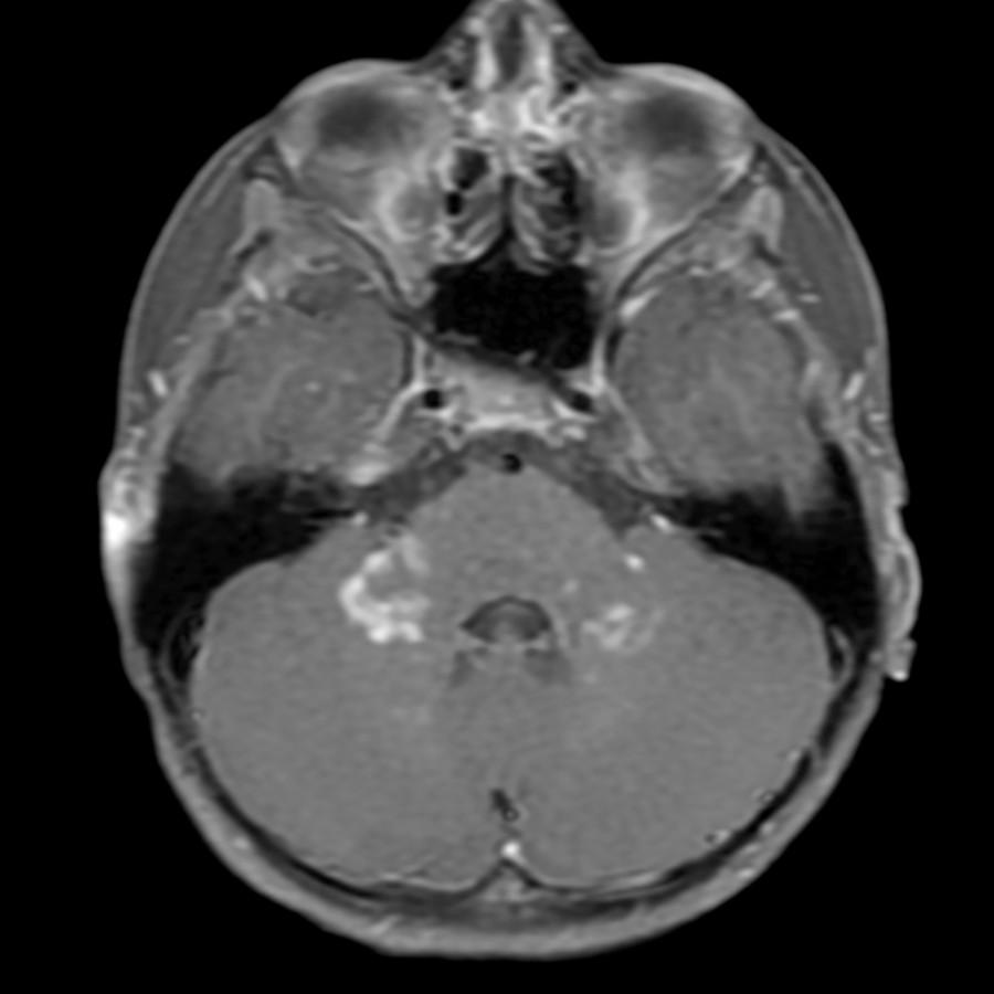 Axial T1 C+ FS MR in the same patient reveals patchy partial ring and nodular enhancement in these abnormal areas.