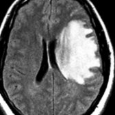 Axial FLAIR MR demonstrates a large, tumefactive, hyperintense lesion. Less mass effect is present than expected for lesion size. Smaller lesions were also present at other locations.