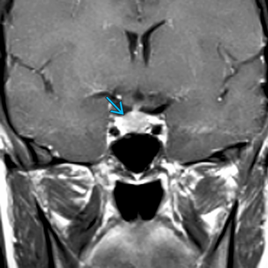 Coronal T1 C+ MR in a young, postpartum, lactating female shows an upwardly bulging pituitary gland . Physiologic hyperplasia with gland measured almost 12 mm in height.