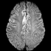 Axial DWI MR of a 59-year-old woman patient with rapidly progressive dementia and myoclonus demonstrates asymmetric patchy cortical restricted diffusion (cortical ribbon sign)  in cingulate gyri and frontal lobe. EEG showed periodic sharp wave complexes.