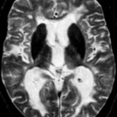 Axial T2WI MR demonstrates very hypointense bilateral basal ganglia, atrophy (evidenced by ventricular prominence), and confluent periventricular/subcortical hyperintense plaques in this patient with advanced MS.