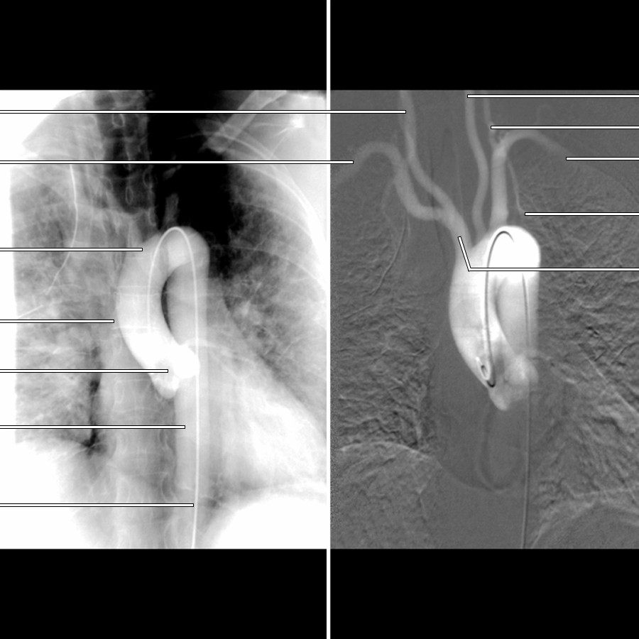 Corresponding frontal projection of a catheter angiogram (left) and digital subtraction image (right) of the thoracic aorta illustrate normal anatomy of the aorta and great vessel origins.