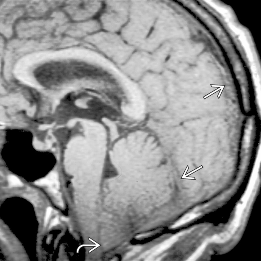 Sagittal T1WI MR shows tonsillar descent  and dural thickening  secondary to intracranial hypotension.