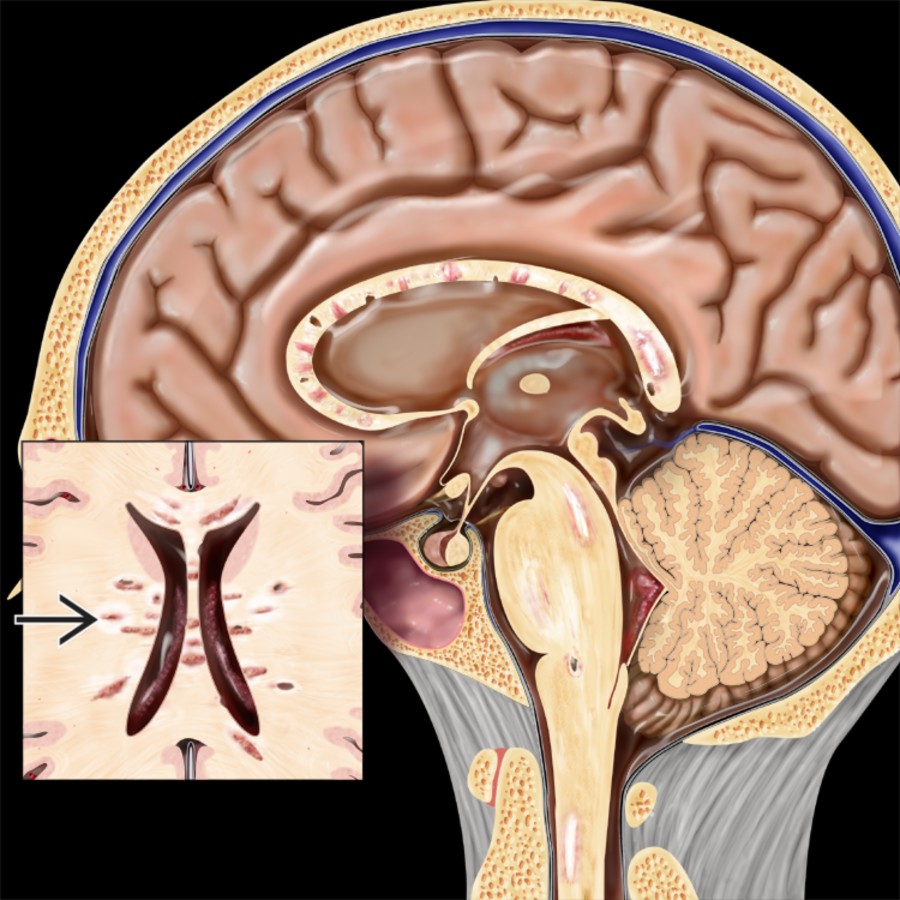 Sagittal graphic illustrates multiple sclerosis (MS) plaques involving the corpus callosum, pons, and spinal cord. Note the characteristic perpendicular orientation of the lesions  at the callososeptal interface along penetrating venules.