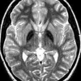 Axial T2WI MR shows diffusely hypointense globus pallidus in a 15 year old with spastic gait. Lack of eye of the tiger indicates lack of PANK2 mutation. These patients have other forms of neurodegeneration with brain iron accumulation (NBIA(, not PKAN.