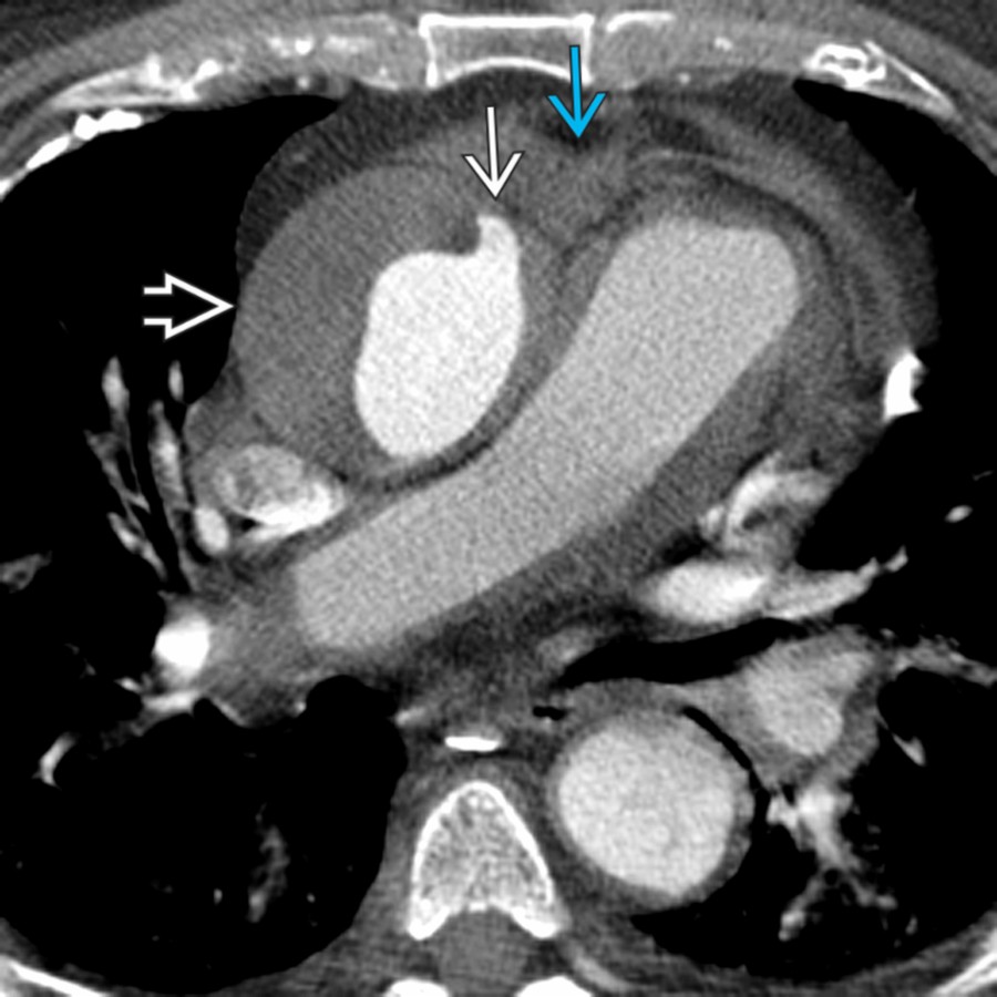 Axial CTA in a 23-year-old man with a stab wound to the anterior chest shows mediastinal hemorrhage  and laceration  of the anteromedial ascending aorta with adjacent intramural hematoma .