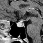 Sagittal T1 C+ FS MR in a 41-year-old peripartum woman with headache and multiple endocrine deficiencies demonstrates enlargement of the pituitary gland and infundibular stalk, classic MR findings for LH. The lesion resolved with corticosteroids and endocrine replacement.