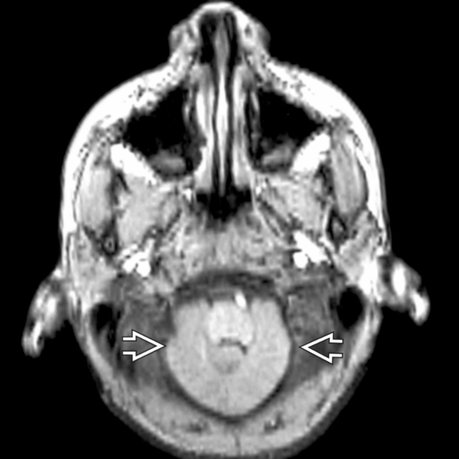 Axial FSPGR image demonstrates caudally displaced cerebellar tissue  wrapping around the brainstem. This is sometimes referred to as a "creeping cerebellum" due to a small posterior fossa.
