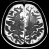 Axial T2WI MR in a patient with classic FTD shows predominantly frontal lobar atrophy with knife-like gyri . In this case, an associated region of hyperintense white matter    is present.