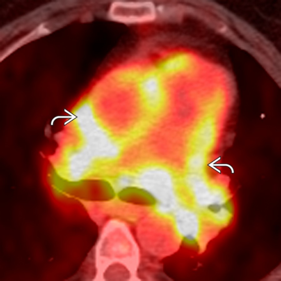 Axial fused PET/CT in the same patient shows intense FDG uptake within the mediastinum adjacent to the ascending aorta and pulmonary arteries . FDG uptake may be low grade to intense in TA, and PET/CT is an effective way of monitoring treatment response.