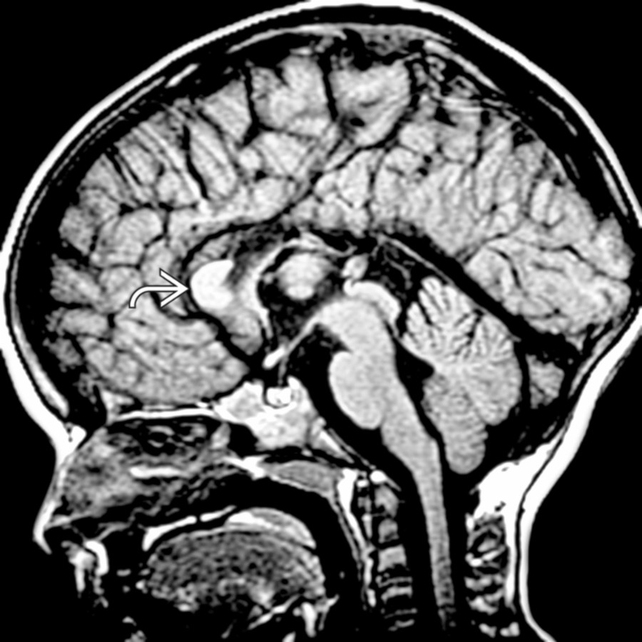 Midline sagittal T1 MR shows only a residual genu  of the corpus callosum with absence of the body & splenium as well as truncation of the rostrum.