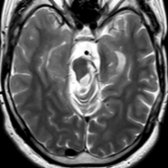 Axial T2 MR shows a 29-year-old man who developed palatal myoclonus several months following midbrain surgery for cavernous malformation. Imaging was obtained 1 year after surgery. This scan through the upper midbrain shows atrophy of the left pons & cerebral peduncle .