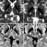 A 52-year-old male patient with ALS presenting with progressive bilateral lower extremity weakness followed by upper extremity weakness is shown. Axial T2WI (top)  and FLAIR (bottom)   show hyperintense signal involving the internal capsules posterior limb.