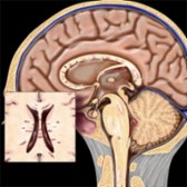 Sagittal graphic illustrates multiple sclerosis (MS) plaques involving the corpus callosum, pons, and spinal cord. Note the characteristic perpendicular orientation of the lesions  at the callososeptal interface along penetrating venules.