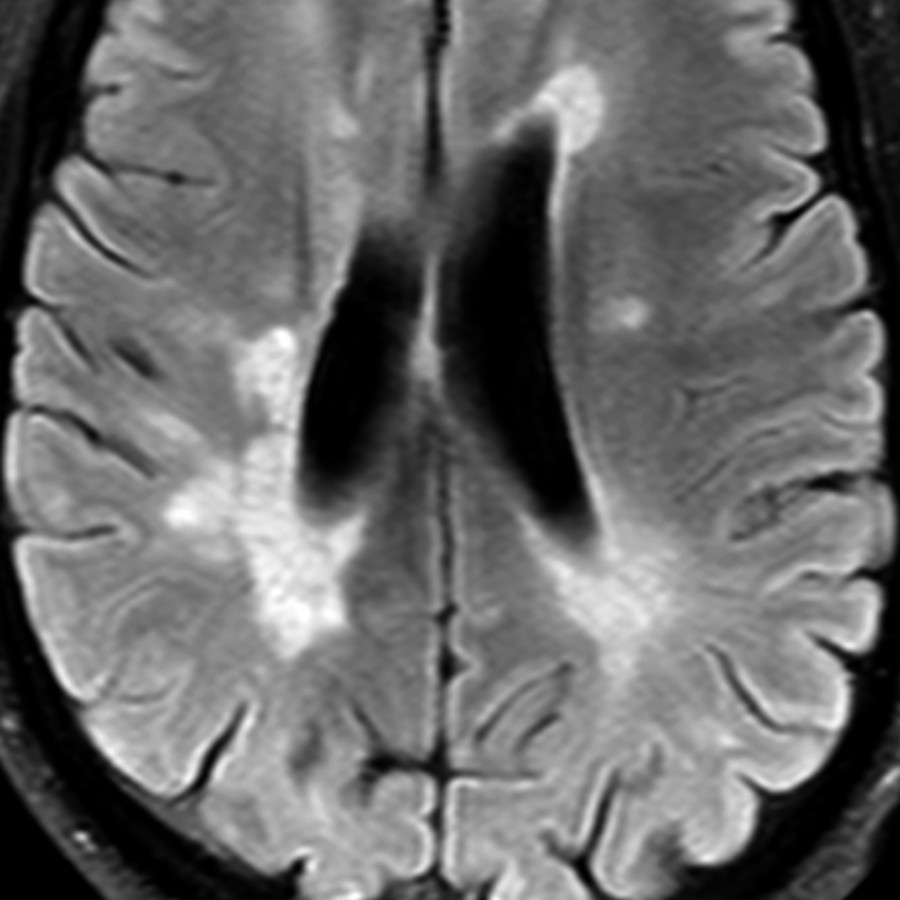 Axial FLAIR MR 3T shows multiple nonenhancing, periventricular, hyperintense MS lesions oriented perpendicular to the callosomarginal interface. These lesions are perivenular along the path of the deep medullary veins and represent Dawson fingers. Confluent lesions are also seen along the right periventricular margin.