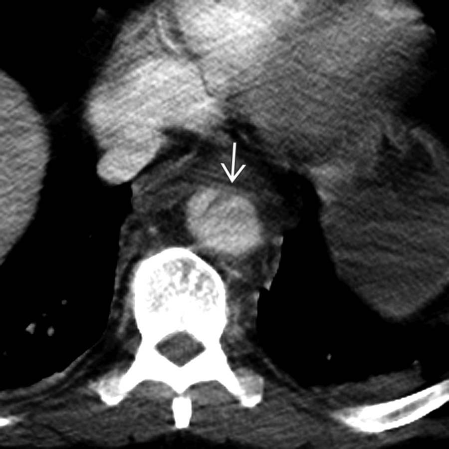 Axial CTA of the chest in a 60-year-old unrestrained man following a high-speed motor vehicle collision shows a linear tear from the anterior aspect of the descending aorta at the level of the diaphragm . The patient was hemodynamically unstable and was brought to the operating room.
