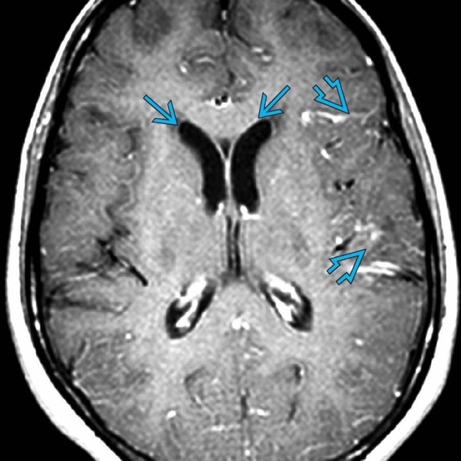 Axial T1WI C+ MR demonstrates subtle leptomeningeal enhancement in the left sylvian fissure  in this patient with tuberculous meningitis. There is mild dilatation of the lateral ventricles  due to extraventricular obstructive hydrocephalus.