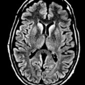 Axial FLAIR MR in the same patient demonstrates hyperintense signal in bilateral BG  and cortex . CSF was positive for 14-3-3 protein indicating probable sCJD.