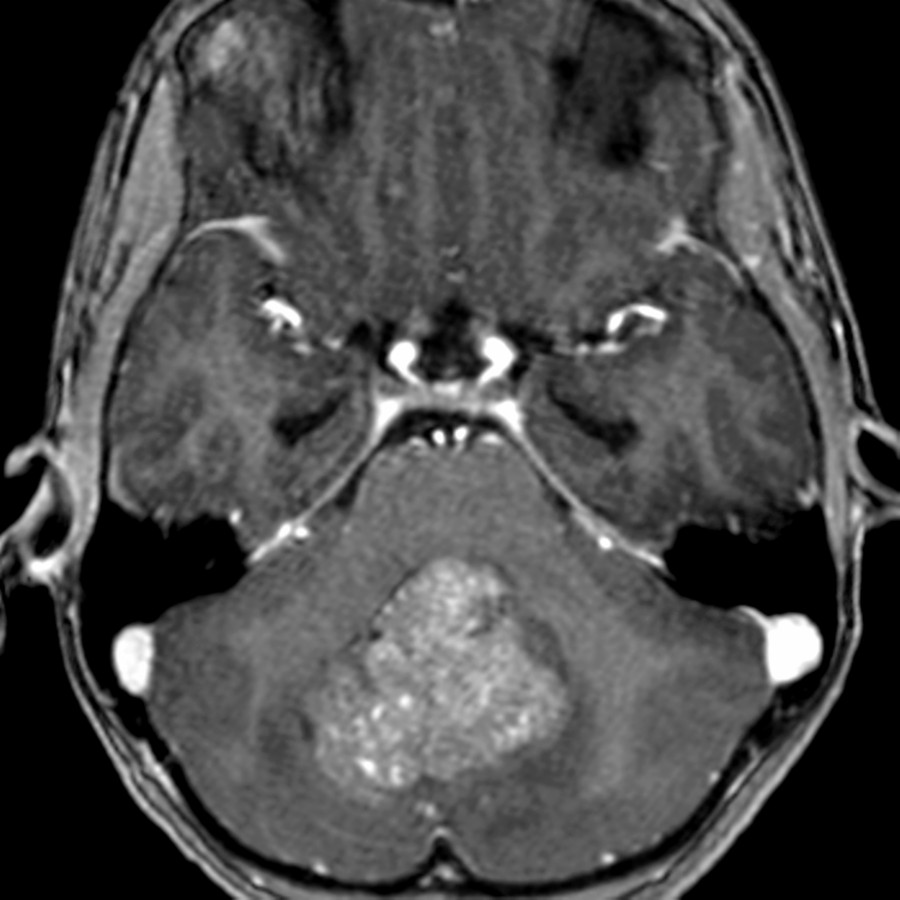 Axial T1 C+ FS MR shows a heterogeneously enhancing mass filling the 4th ventricle. This was a group 1 medulloblastoma with Wingless (WNT) activation. These are rare medulloblastomas, but they have a very good prognosis. They are typically seen near the cerebellopontine angle in older children.