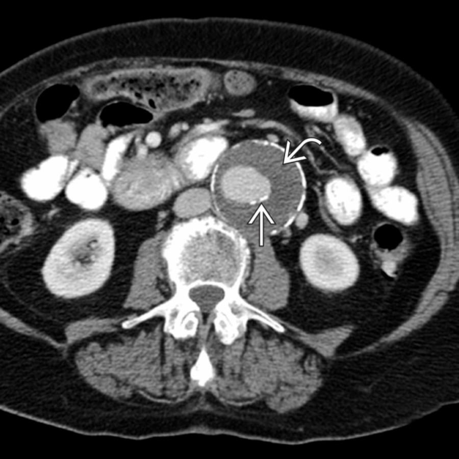 Axial CECT shows dilated abdominal aorta with extensive mural thrombus . Calcifications  occur when the thrombus is chronic and does not represent displaced intimal calcifications.