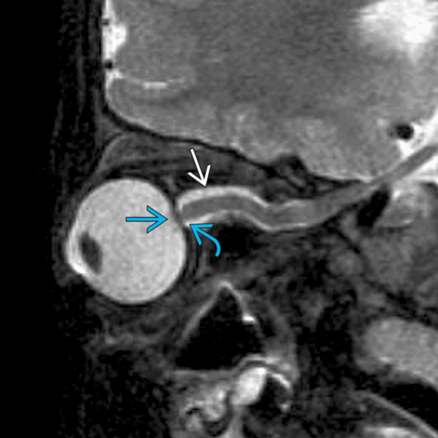 Sagittal T2 FS MR in the same patient shows tortuosity of the optic nerve, dilated optic nerve sheath , flattening of the posterior sclera , and mild bulging of the optic nerve disc head  due to papilledema. Findings are typical of idiopathic intracranial hypertension (IIH). Childhood obesity has a strong association with ↑ risk of pediatric IIH.