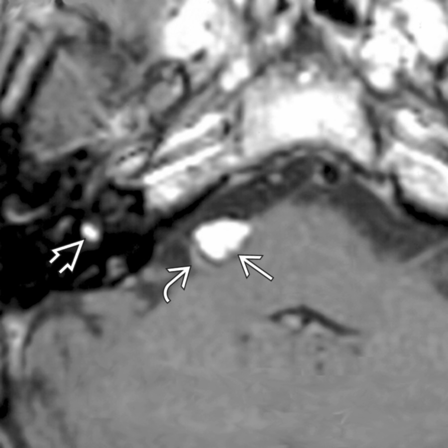 Axial T1 MR demonstrates a CPA  and intravestibular  lipoma. Notice that the CPA lipoma effaces the most proximal vestibulocochlear nerve bundle . These lesions are left alone.