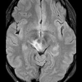 Axial FLAIR MR in a patient with NMO demonstrates an ill-defined hyperintense lesion involving the right cerebral peduncle and midbrain .