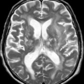 Axial T2 MR in a 72-year-old man with VaD demonstrates multiple remote lacunar infarcts in bilateral deep gray nuclei  and extensive white matter (WM) hyperintensity  due to chronic WM ischemic changes. Also note prominent cortical sulci  due to cerebral atrophy.