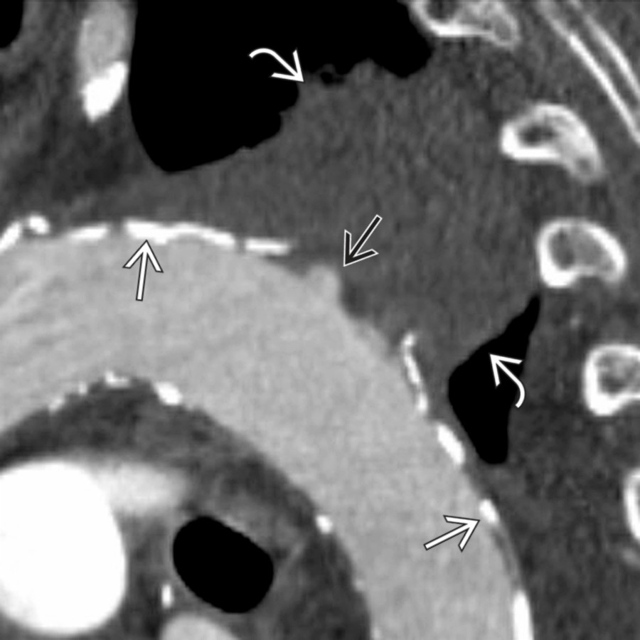 Sagittal oblique CTA in the same patient shows extensive atherosclerosis of the aorta  with a small, penetrating ulcer  and a large focal mural hematoma . PAUs are associated with a variable degree of intramural hematoma (IMH), either focal (as in this case) or diffuse.