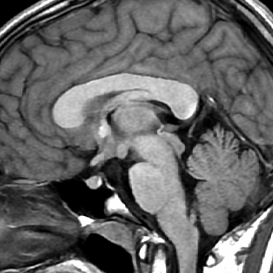 Midline sagittal T1 MR in a 15 year old with neurofibromatosis type 1 (NF1) shows diffuse marked thickening of the entire CC, a finding that can be seen in NF1. Look for associated findings of NF1, such as nonenhancing signal abnormalities of the globus pallidus & medial cerebellum, optic pathway gliomas, & plexiform neurofibromas.