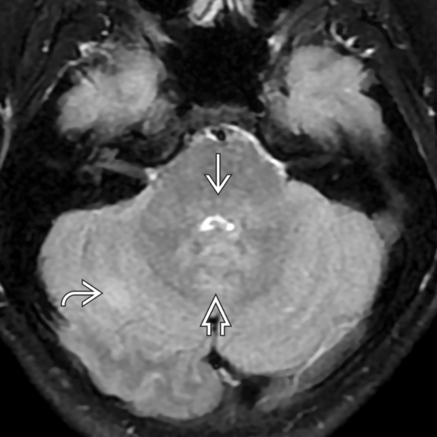Axial FLAIR MR in the same patient additionally reveals brainstem/cerebellar peduncle , deep cerebellar white matter  , and cerebellar hemisphere  lesions.