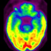 Axial FDG PET in a patient with FTD shows decreased glucose metabolism in frontal   & temporal  lobes. The parietal & occipital lobes  are spared.