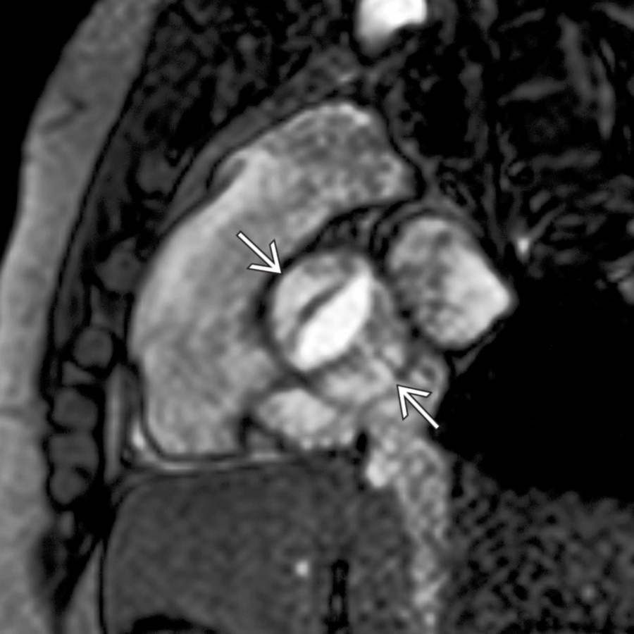 Double oblique cine MR shows a bicuspid aortic valve  in a young patient with a dilated ascending aorta. This image can be used to calculate valve area to quantify stenosis.