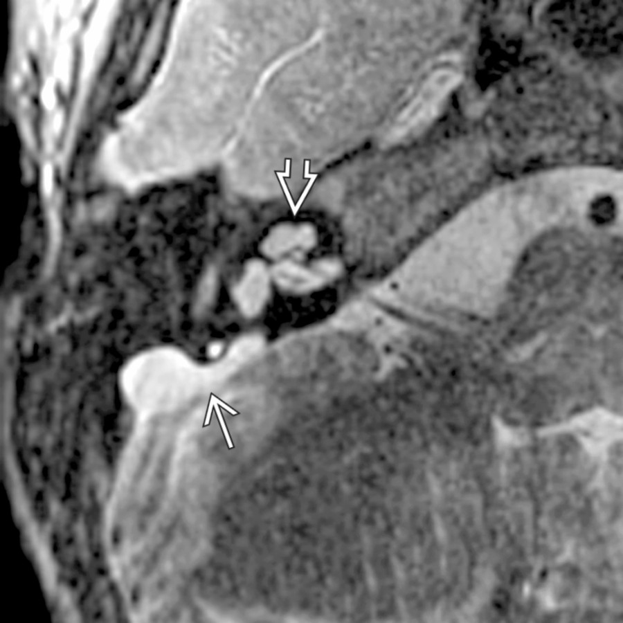 Axial T2WI FS MR shows a large endolymphatic sac  along the posterior wall of the T-bone associated with a malformed cochlea (modiolar deficiency, incomplete apical septation, and bulbous apical turn) .