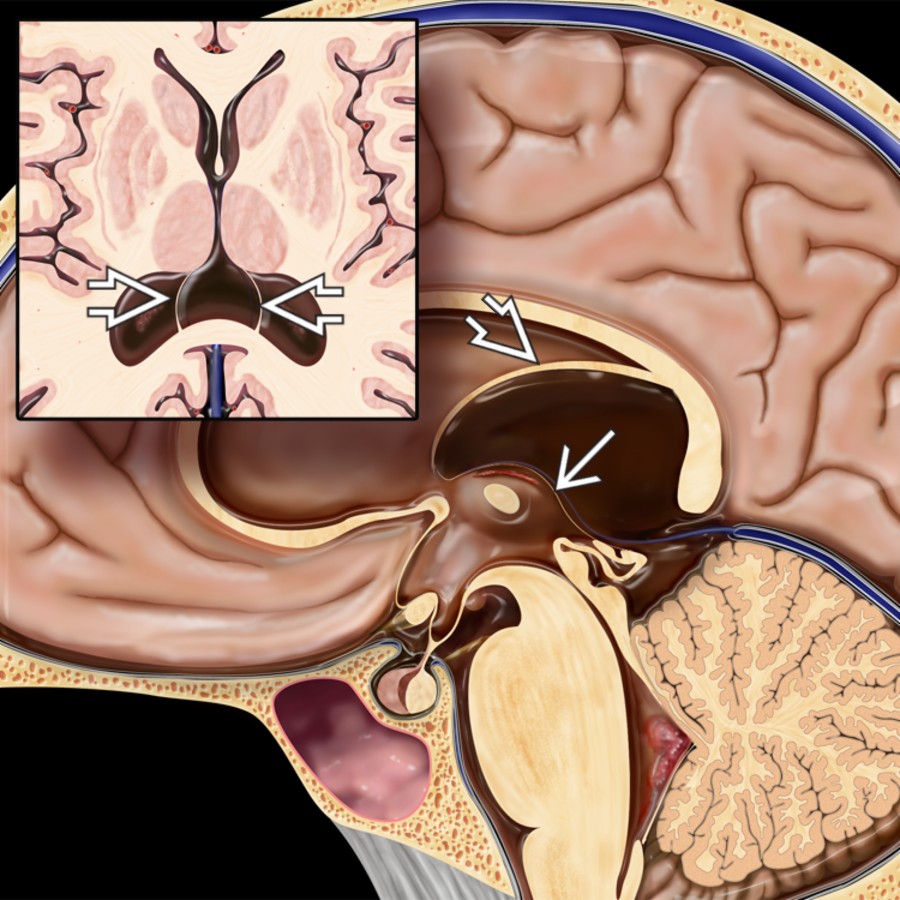 Sagittal graphic with axial insert shows a cavum velum interpositum (CVI). Note the elevation and splaying of the fornices . Also noted is the inferior displacement of the internal cerebral veins and 3rd ventricle .
