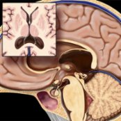 Sagittal graphic with axial insert shows a cavum velum interpositum (CVI). Note the elevation and splaying of the fornices . Also noted is the inferior displacement of the internal cerebral veins and 3rd ventricle .