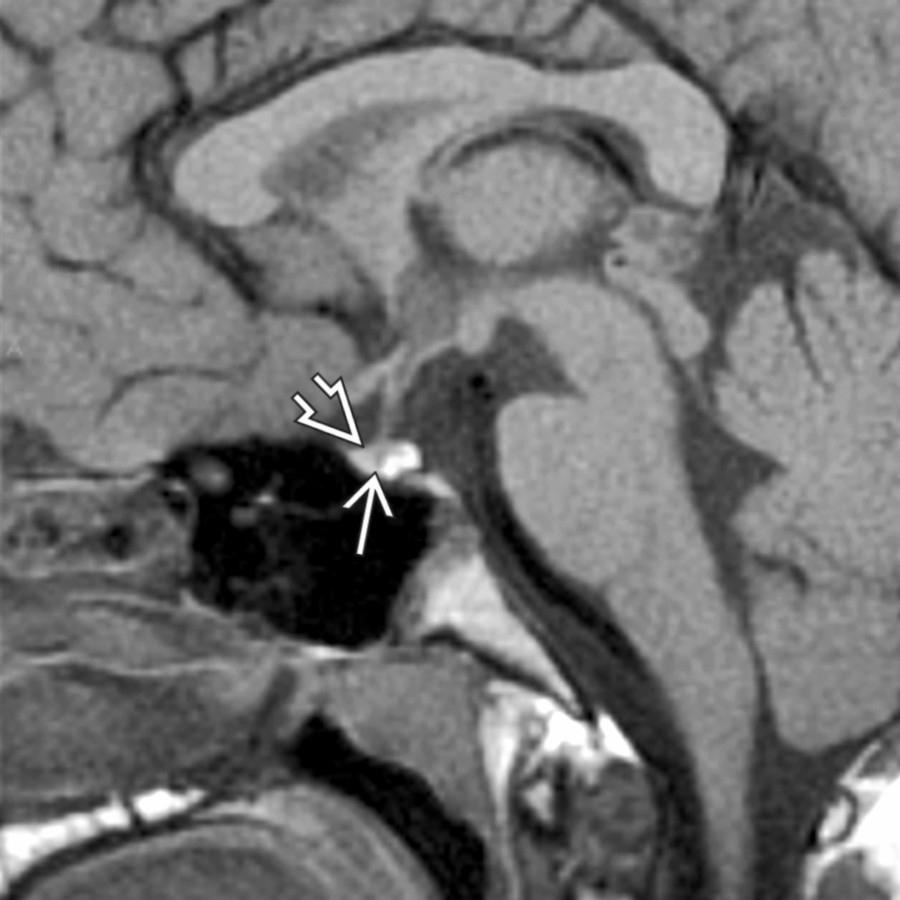Sagittal T1 MR shows a small, shallow sella  and pituitary  in a patient with Kallmann syndrome with hypopituitarism. Small sella also occurs as a normal variant, indistinguishable on imaging alone.
