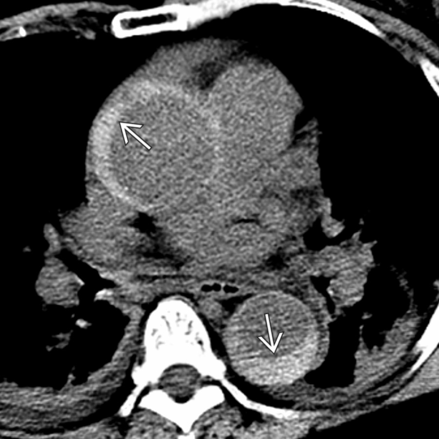 Axial chest NECT in a patient with chest pain and type A IMH shows crescentic hyperdensity , consistent with IMH along the ascending and descending thoracic aorta.