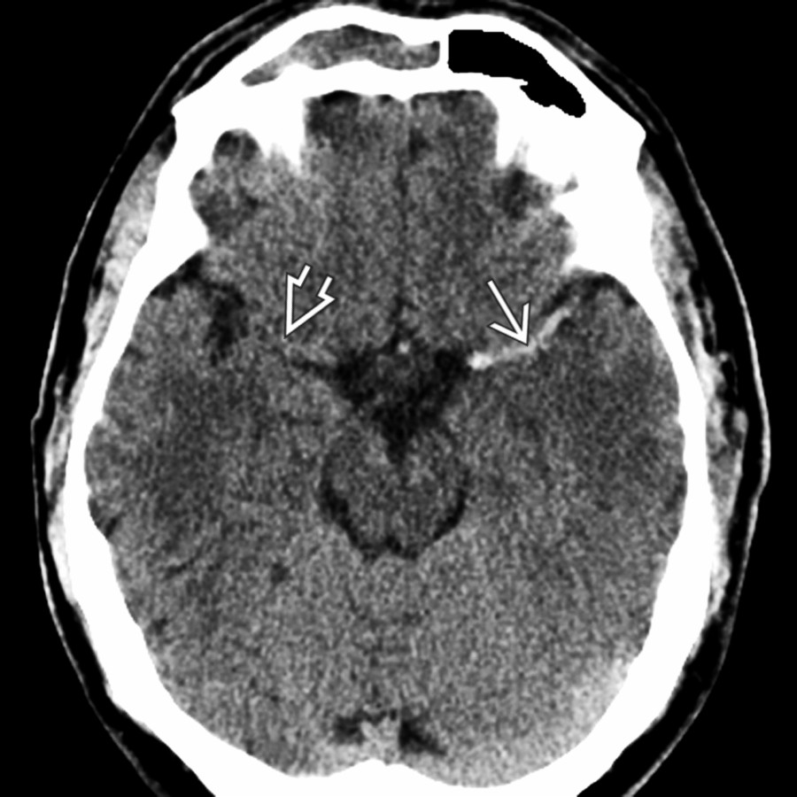 Axial NECT in a 46-year-old man shows a very "dense" left MCA  compared to the normal minimally hyperdense right MCA .