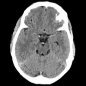Axial NECT shows a hyperdense middle cerebral artery (MCA)   and basilar arteries  in this patient with dehydration. Typically, the circle of Willis arteries are mildly hyperdense compared with normal brain parenchyma. Vessels become prominent in normal newborns with unmyelinated, hypodense brain.