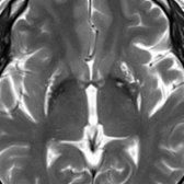 Axial T2WI MR in a 43-year-old woman with neuroferritinopathy (NFT) shows cystic degeneration lined by iron deposits in the bilateral putamina   & GP . Bilateral caudate nuclei also had similar findings (not shown).