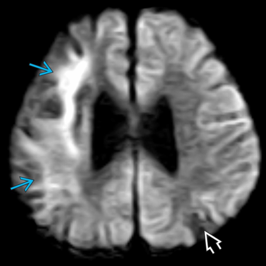 Axial DWI MR in the same patient with moyamoya-type vasculopathy shows diffusion restriction in the right frontoparietal foci of signal abnormality , suggesting an acute/subacute infarct. However, there is no diffusion restriction in the left parietal region , suggesting this infarct is of an older age. Acute stroke should prompt careful arterial evaluation.