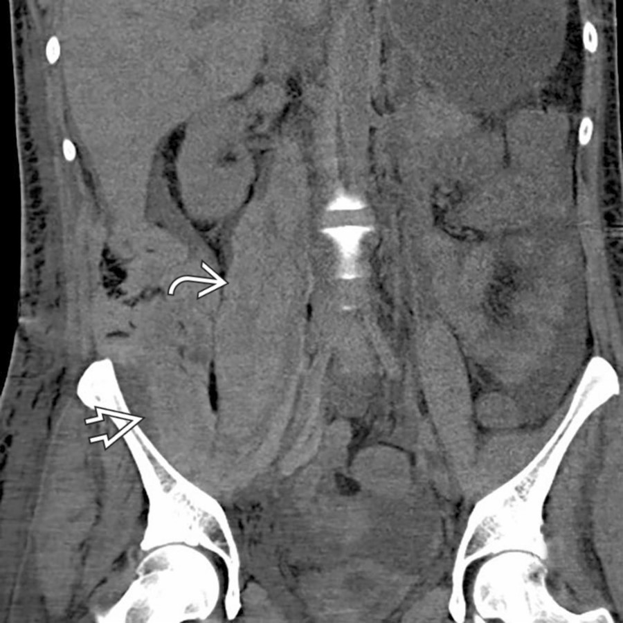 Coronal NECT shows a large hematoma extending from the right psoas muscle  into the adjacent right iliopsoas muscle .
